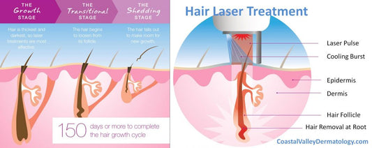 Laser Hair Removal Membership