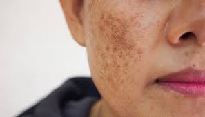 Brown Spots/Discoloration