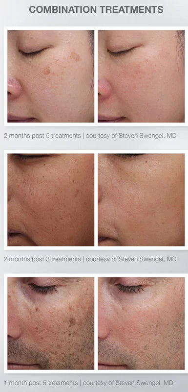 BBL + MOXI Combo Treatment