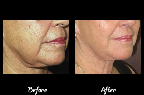 NuEra Jowls & Neck Special
